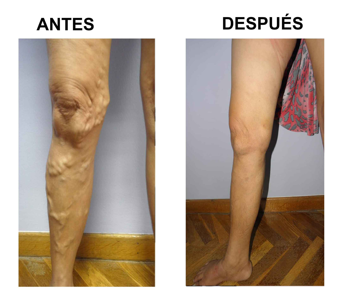 🧦 Alivio para Varices y Piernas Cansadas