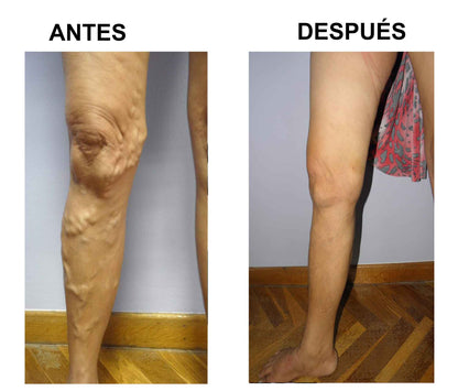 🧦 Alivio para Varices y Piernas Cansadas